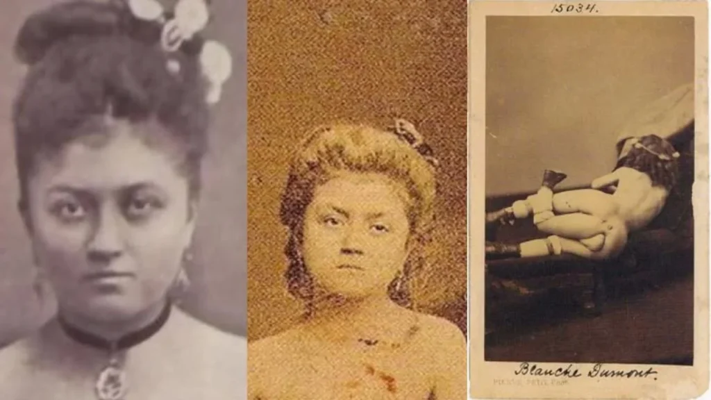 Blanche Dumas: Quién era, edad y lo que se sabe de la mujer de tres piernas