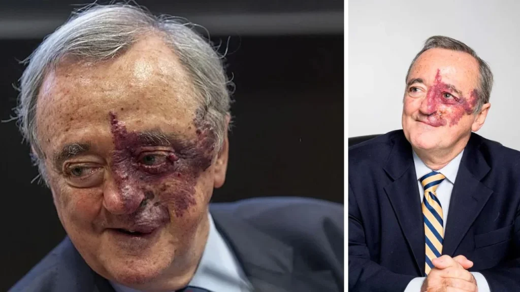 ¿Mariano Barbacid angioma? ¿Qué es la mancha roja que tiene en la cara?