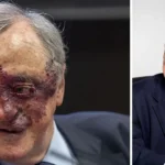 ¿Mariano Barbacid angioma? ¿Qué es la mancha roja que tiene en la cara?