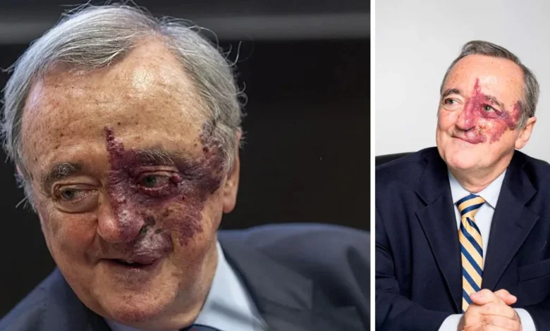 ¿Mariano Barbacid angioma? ¿Qué es la mancha roja que tiene en la cara?