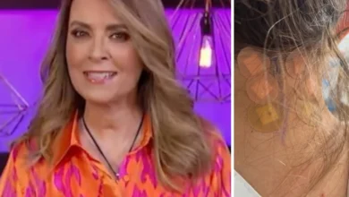 Aurora Valle accidente: Qué le pasó, rizólisis facetaria y últimas noticias