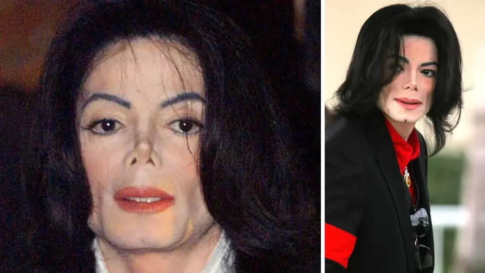 ¿Michael Jackson tenía cáncer? ¿Qué enfermedad tenía, qué es vitiligo?